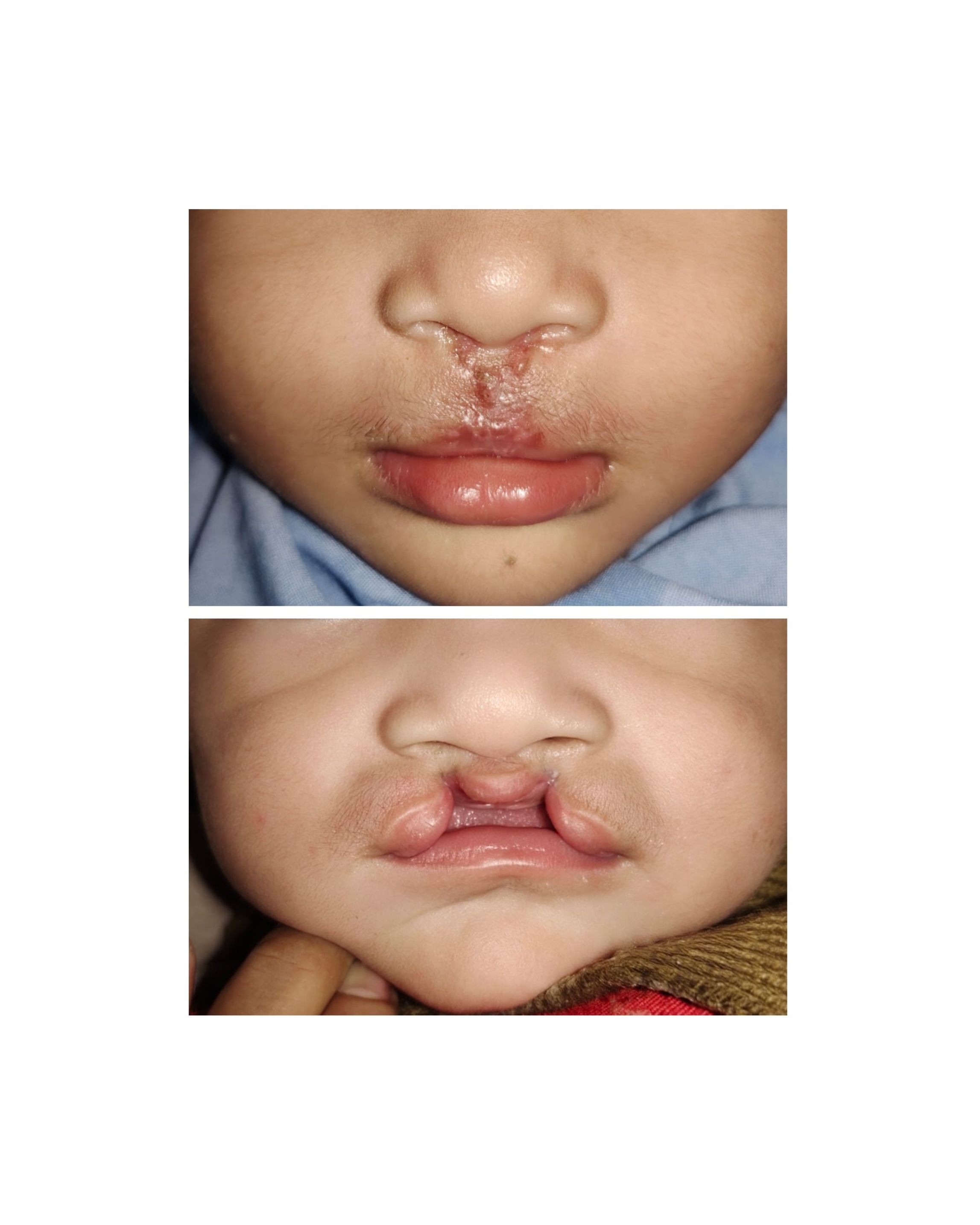 Senyum Baru Keiyan: Operasi Bibir Sumbing Pertama oleh Tim Dokter RSUD Painan